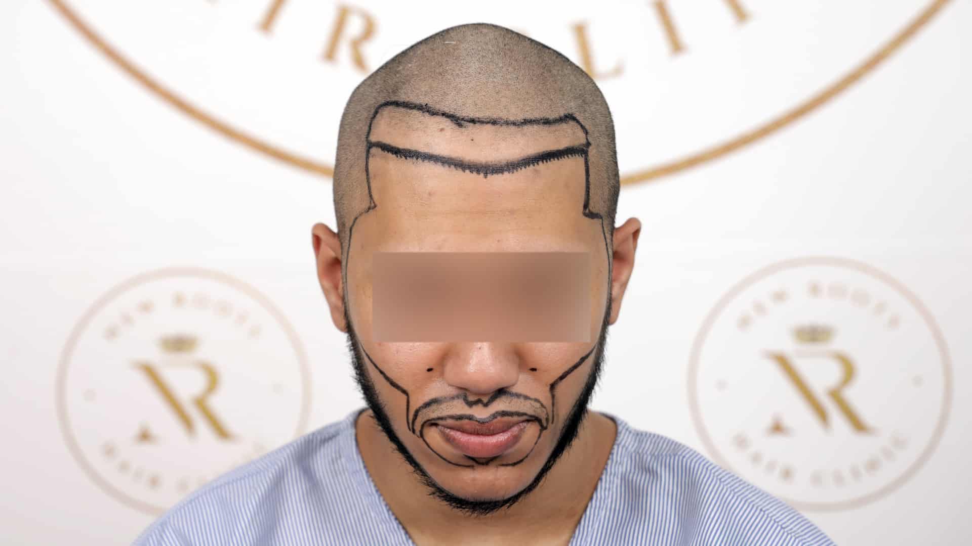 Beard Hair Transplant Before After Images