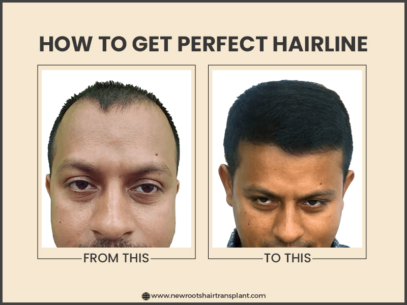 how to get perfect hairline