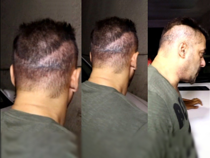 Why did Salman Khan have 3 Hair Transplants Why did Salman Khan have 3 Hair Transplants