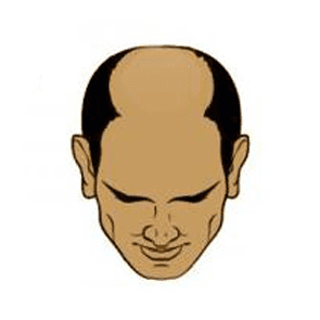 Stages of baldness 6