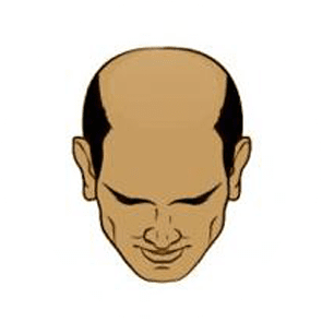 Stages of baldness 7
