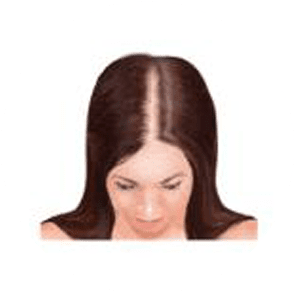 Stages of baldness female 1