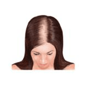 Stages of baldness female 2