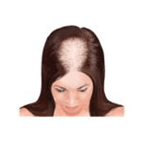 Stages of baldness female 3