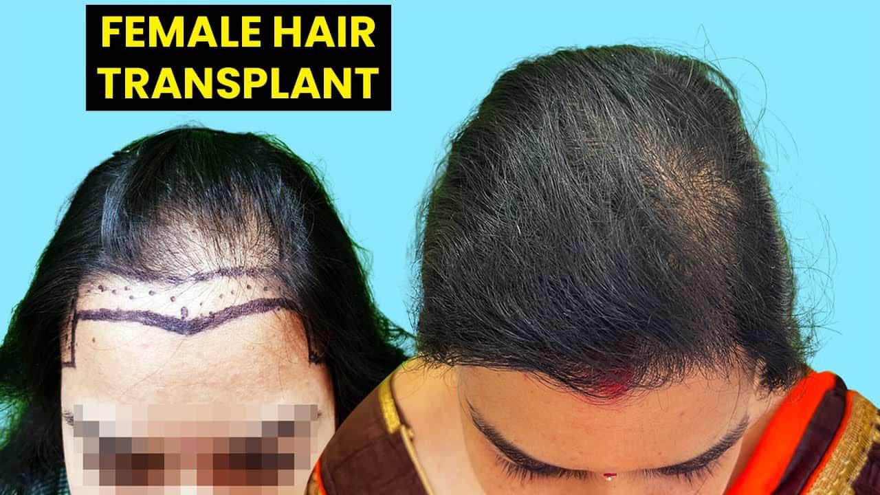 Female Hair Transplant Before After Images