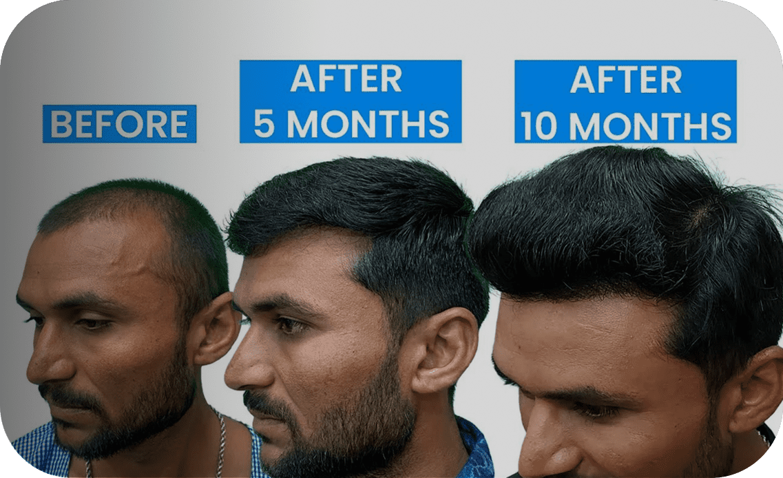 New Roots Hair Clinic | India's Most Trusted Hair Transplant Clinic New Roots Hair Clinic | India's Most Trusted Hair Transplant Clinic