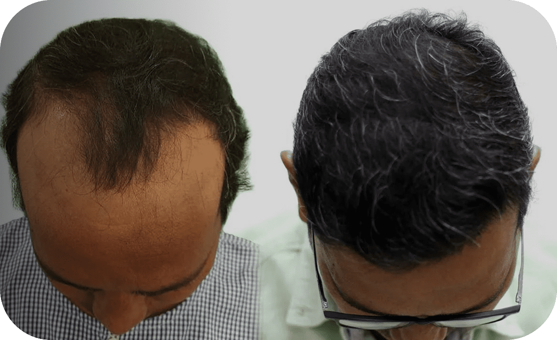 New Roots Hair Clinic | India's Most Trusted Hair Transplant Clinic