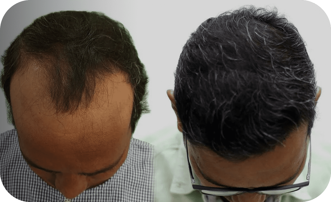 New Roots Hair Clinic | India's Most Trusted Hair Transplant Clinic New Roots Hair Clinic | India's Most Trusted Hair Transplant Clinic