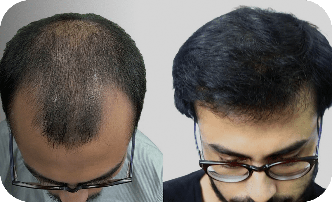 New Roots Hair Clinic | India's Most Trusted Hair Transplant Clinic New Roots Hair Clinic | India's Most Trusted Hair Transplant Clinic