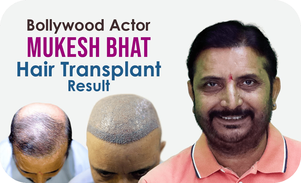 Best Hair Transplant in Mumbai - Know Cost of Hair Transplant