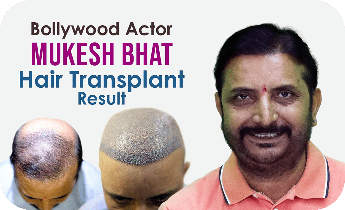 Best Hair Transplant in Mumbai - Know Cost of Hair Transplant Best Hair Transplant in Mumbai - Know Cost of Hair Transplant