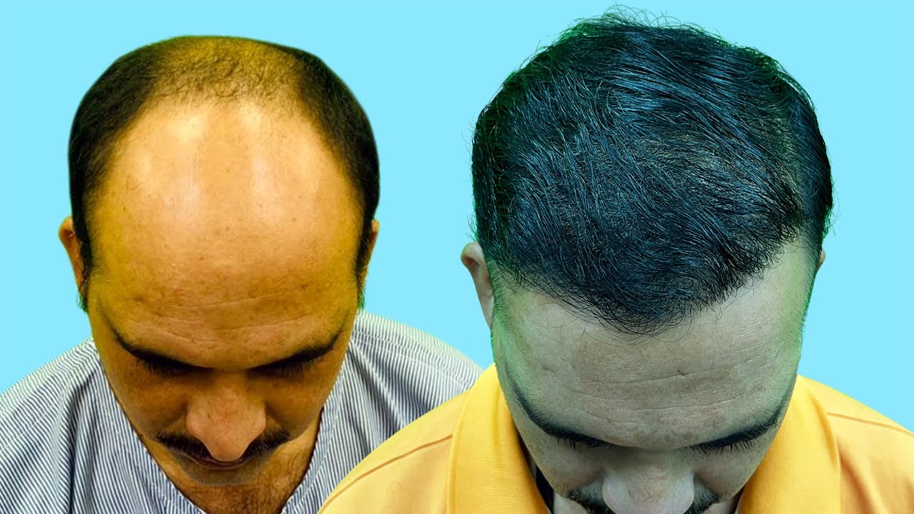 PRP Hair Transplant Before After Images