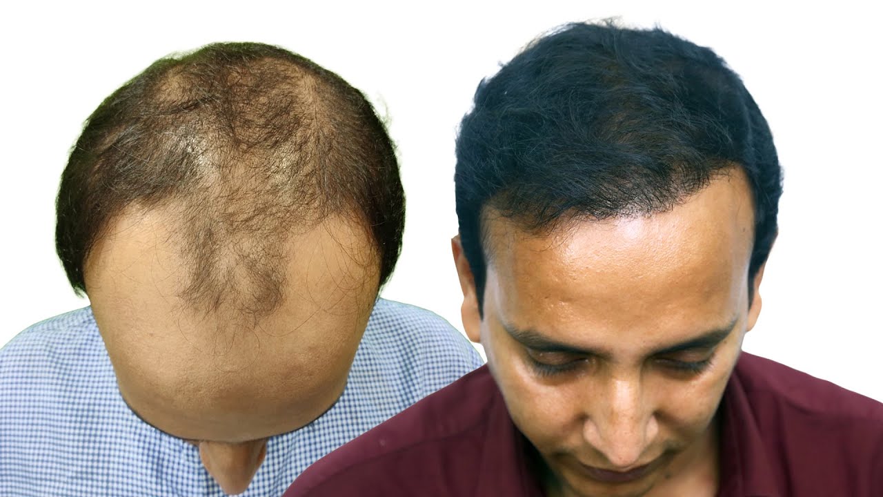 PRP Hair Transplant Before After Images