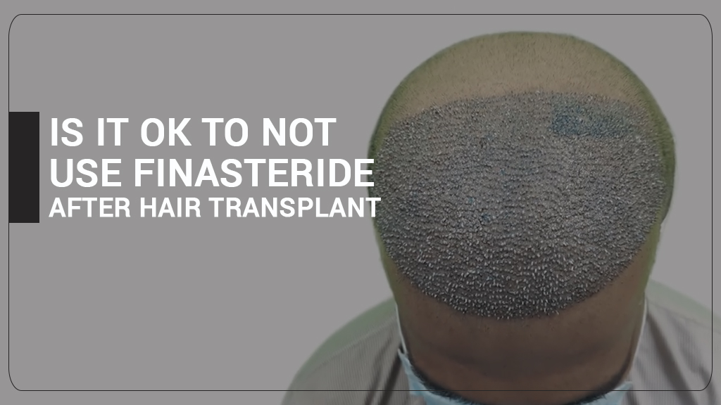 IS IT OK TO NOT USE FINASTERIDE AFTER HAIR TRANSPLANT