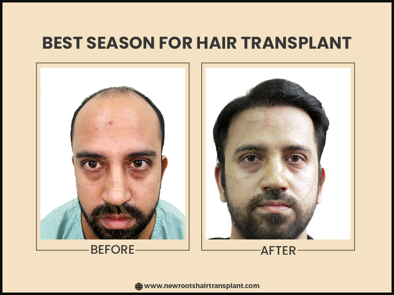 Does weather matter for Hair Transplant in India?