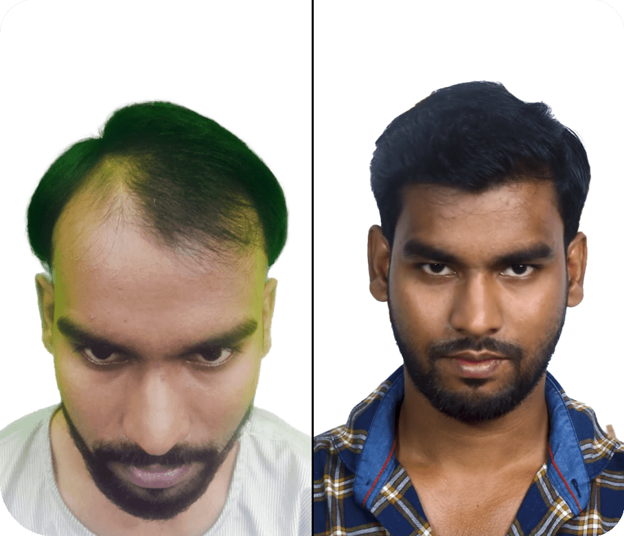 Best Hair Transplant in Mumbai - Know Cost of Hair Transplant