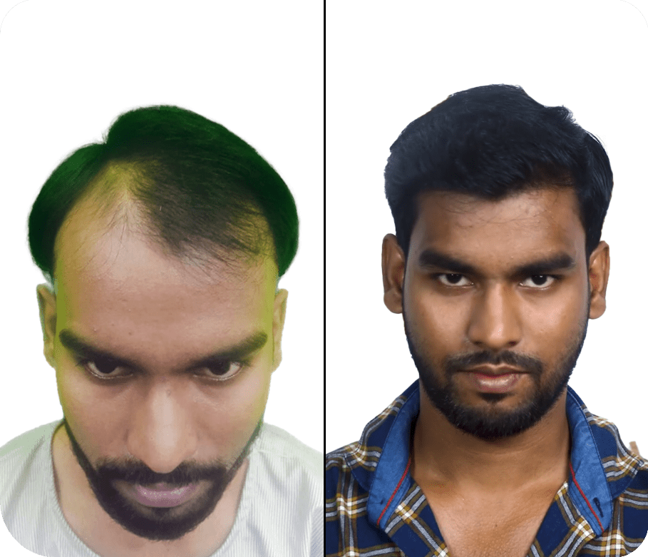 Best Hair Transplant in Mumbai - Know Cost of Hair Transplant Best Hair Transplant in Mumbai - Know Cost of Hair Transplant