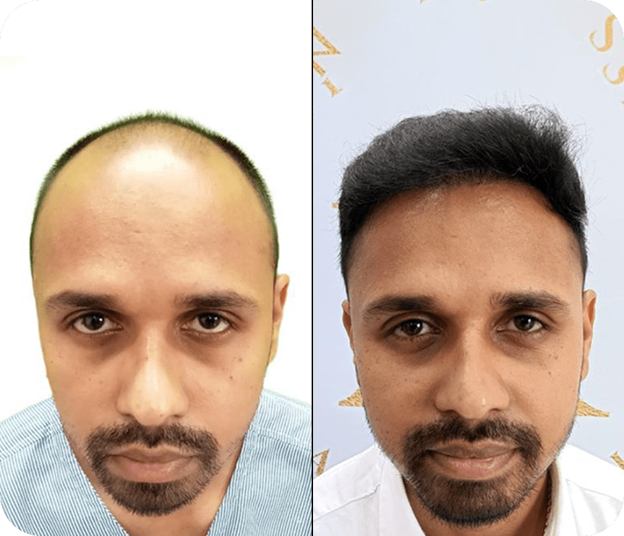 Hair Transplant before after Images 1