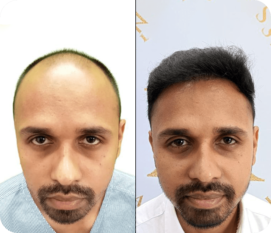 Best Hair Transplant Clinic in India | Hair Transplant Cost | New Roots Hair Clinic Best Hair Transplant Clinic in India | Hair Transplant Cost | New Roots Hair Clinic