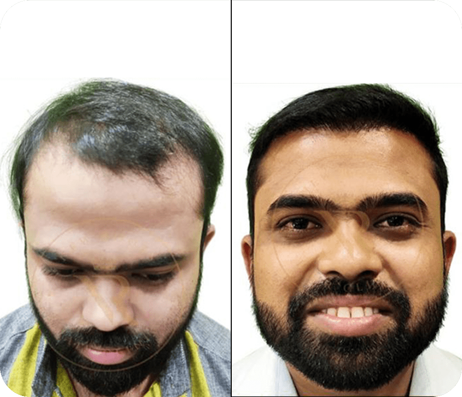Hair Transplant before after Images 10