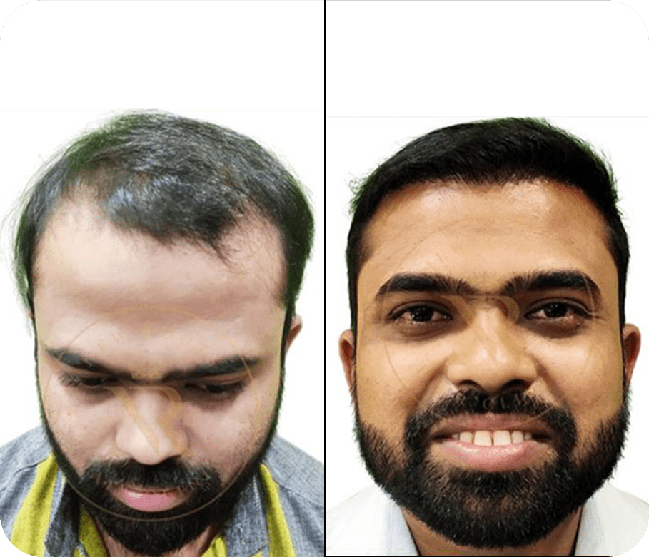 Best Hair Transplant Clinic in India | Hair Transplant Cost | New Roots Hair Clinic Best Hair Transplant Clinic in India | Hair Transplant Cost | New Roots Hair Clinic