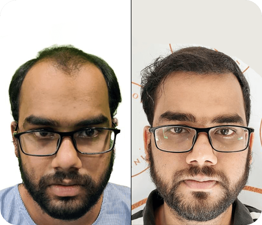 Best Hair Transplant Clinic in India | Hair Transplant Cost | New Roots Hair Clinic Best Hair Transplant Clinic in India | Hair Transplant Cost | New Roots Hair Clinic