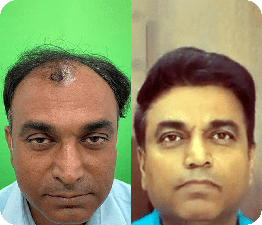 Hair Transplant before after Result 3