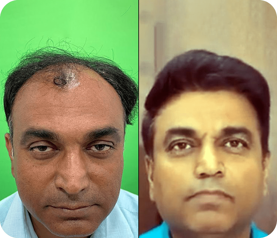 Best Hair Transplant Clinic in India | Hair Transplant Cost | New Roots Hair Clinic Best Hair Transplant Clinic in India | Hair Transplant Cost | New Roots Hair Clinic