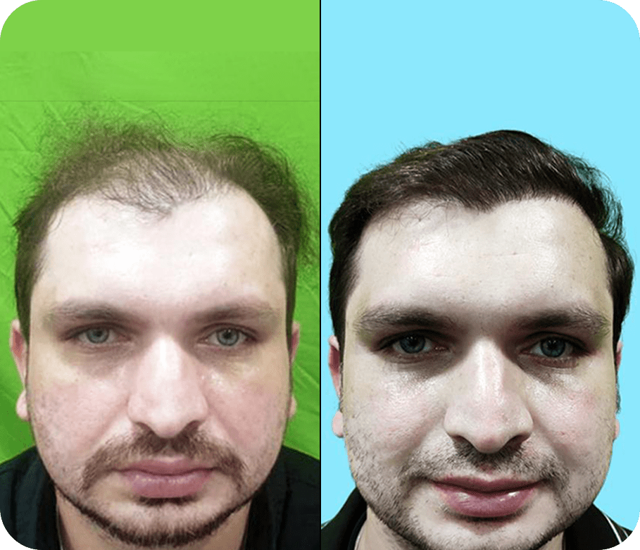 Hair Transplant before after Result 4