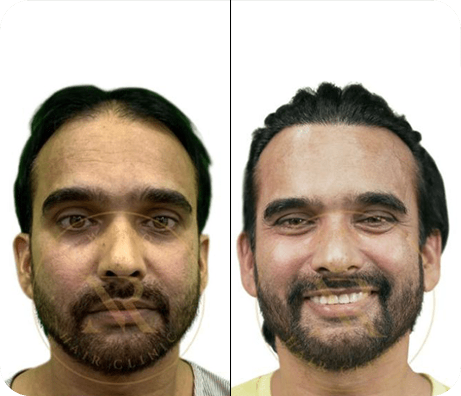 Hair Transplant before after Photos 6