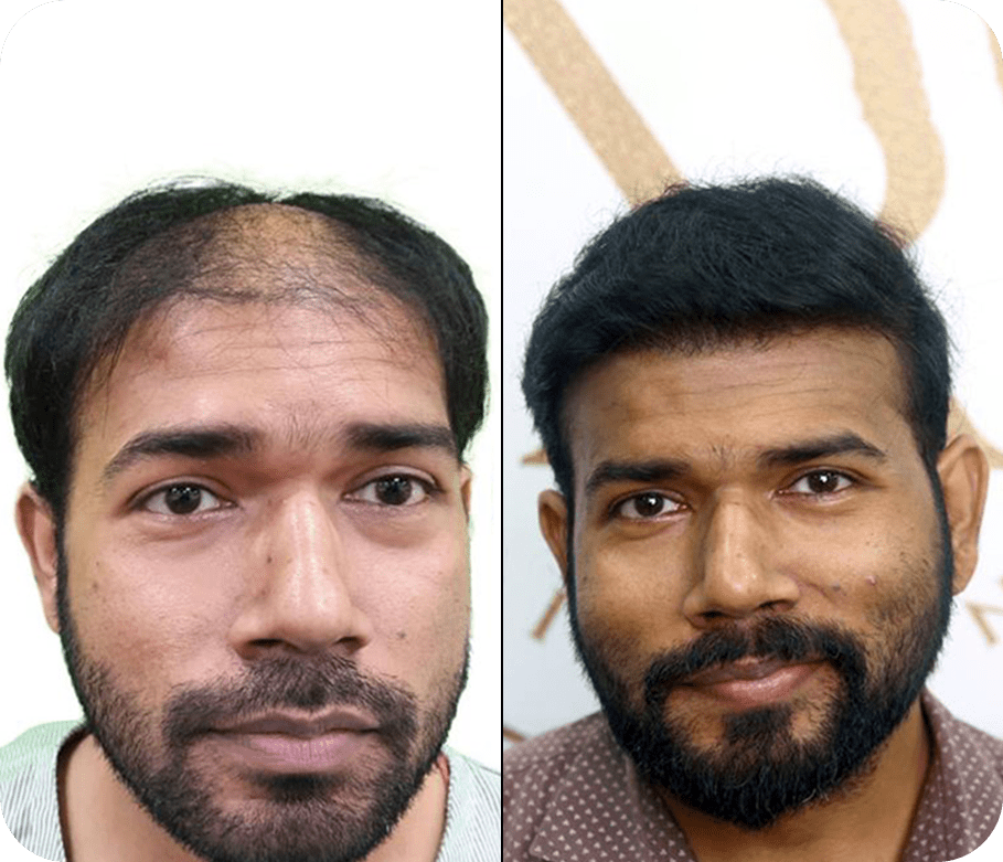 Hair Transplant before after Images 7