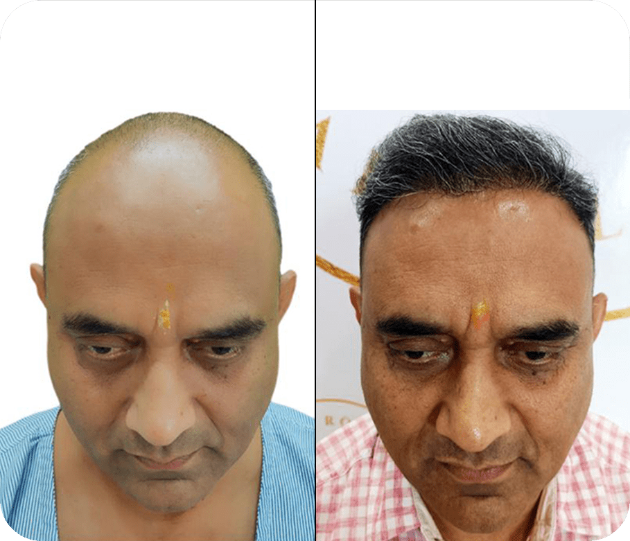 Hair Transplant before after Images 8