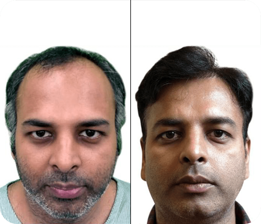 Hair Transplant before after Images 9