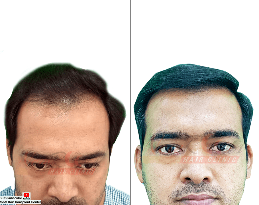 hair transplant images