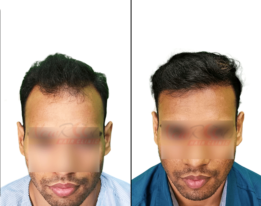 hair transplant pictures