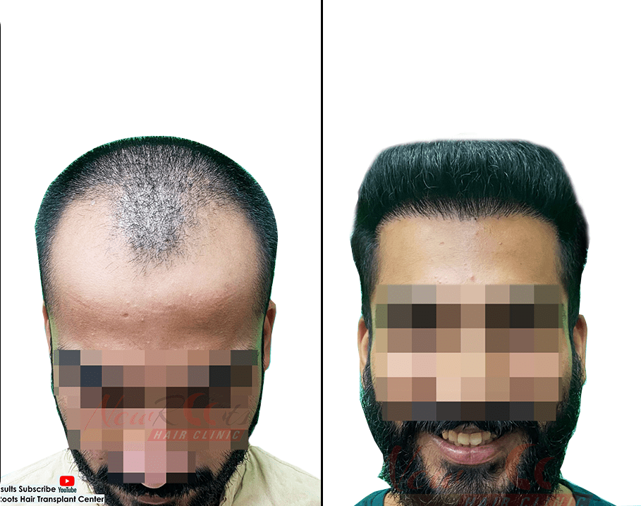 hair transplant photos