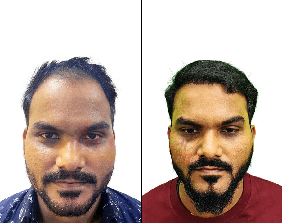 hair transplant pics