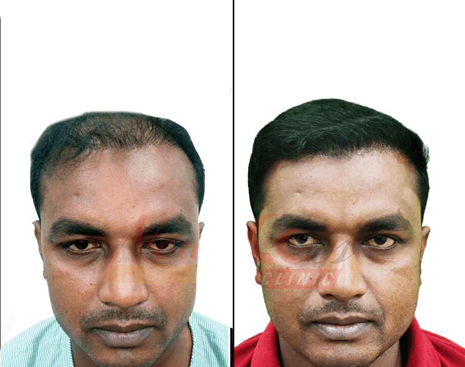 hair transplant images before and after