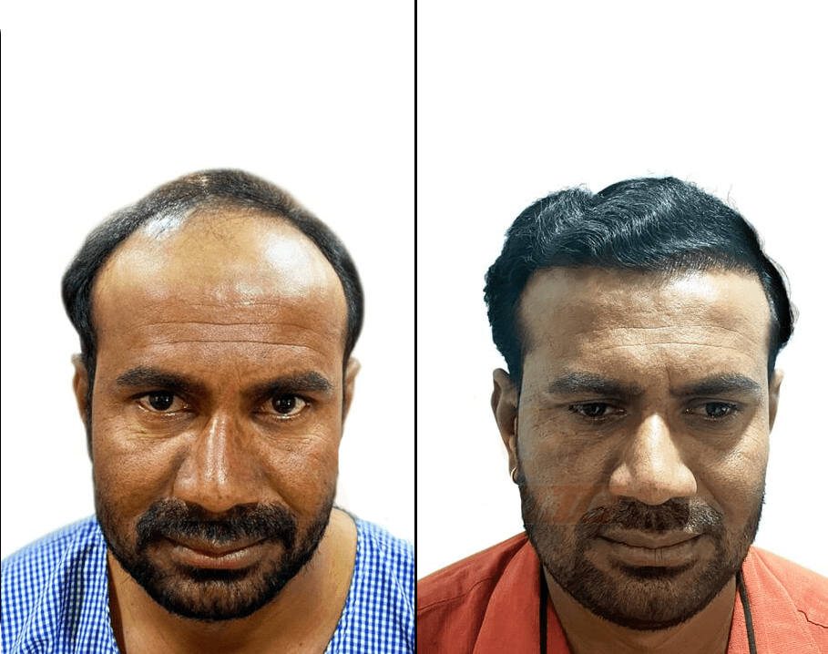 Suffering from Hair Loss? – Get the Best Hair Transplant in Nashik