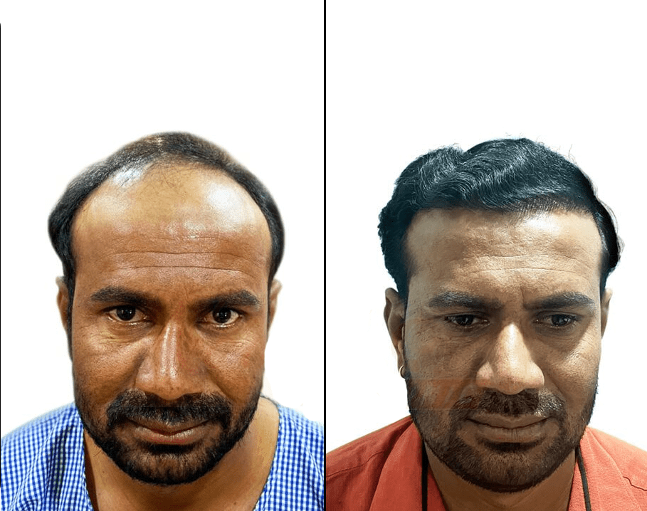 Suffering from Hair Loss? – Get the Best Hair Transplant in Nashik Suffering from Hair Loss? – Get the Best Hair Transplant in Nashik