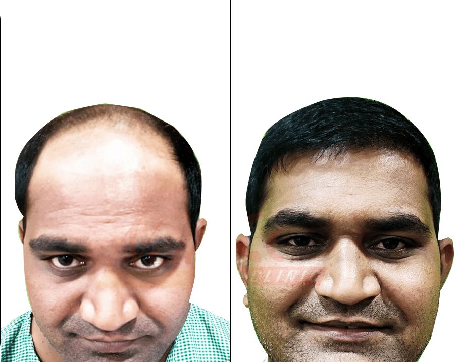 Suffering from Hair Loss? – Get the Best Hair Transplant in Nashik Suffering from Hair Loss? – Get the Best Hair Transplant in Nashik