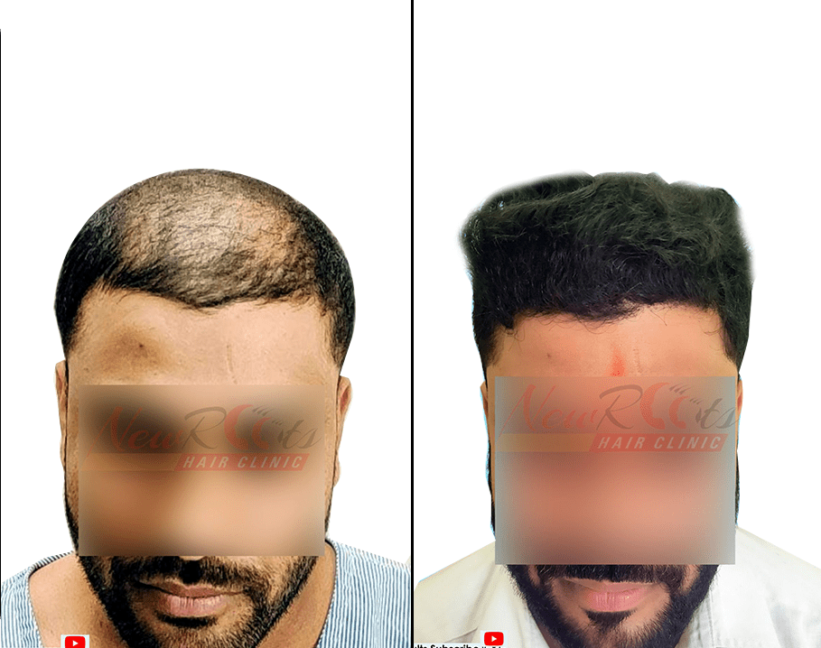 Best Hair Transplant Clinic in Raipur: Cost, Procedure and More Best Hair Transplant Clinic in Raipur: Cost, Procedure and More