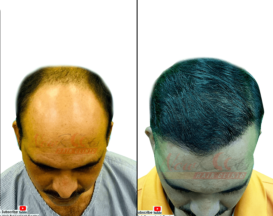 Best Hair Transplant Clinic in Raipur: Cost, Procedure and More