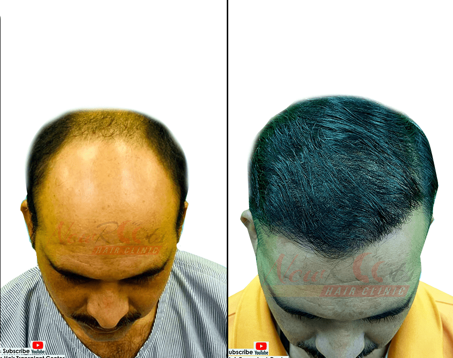 Best Hair Transplant Clinic in Raipur: Cost, Procedure and More Best Hair Transplant Clinic in Raipur: Cost, Procedure and More
