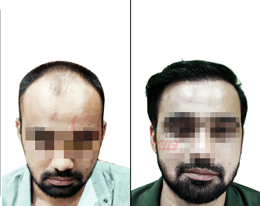 Best Hair Transplant Clinic in Raipur: Cost, Procedure and More