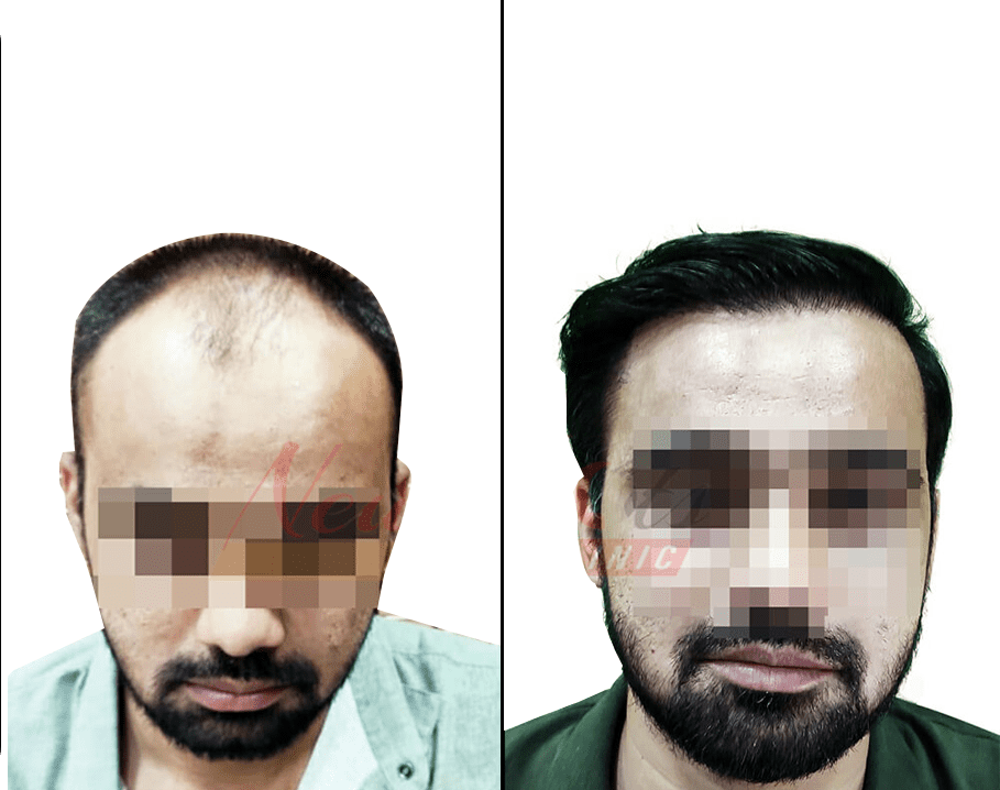 Best Hair Transplant Clinic in Raipur: Cost, Procedure and More Best Hair Transplant Clinic in Raipur: Cost, Procedure and More
