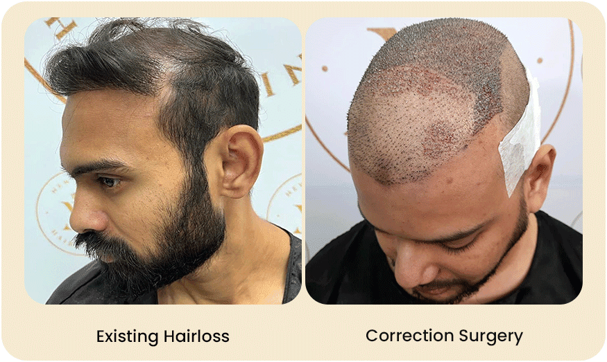 HAIR TRANSPLANT CORRECTION SURGERY Before after Images