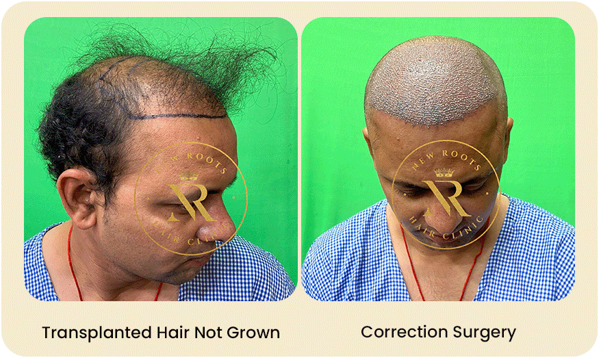 HAIR TRANSPLANT CORRECTION SURGERY Before after Images