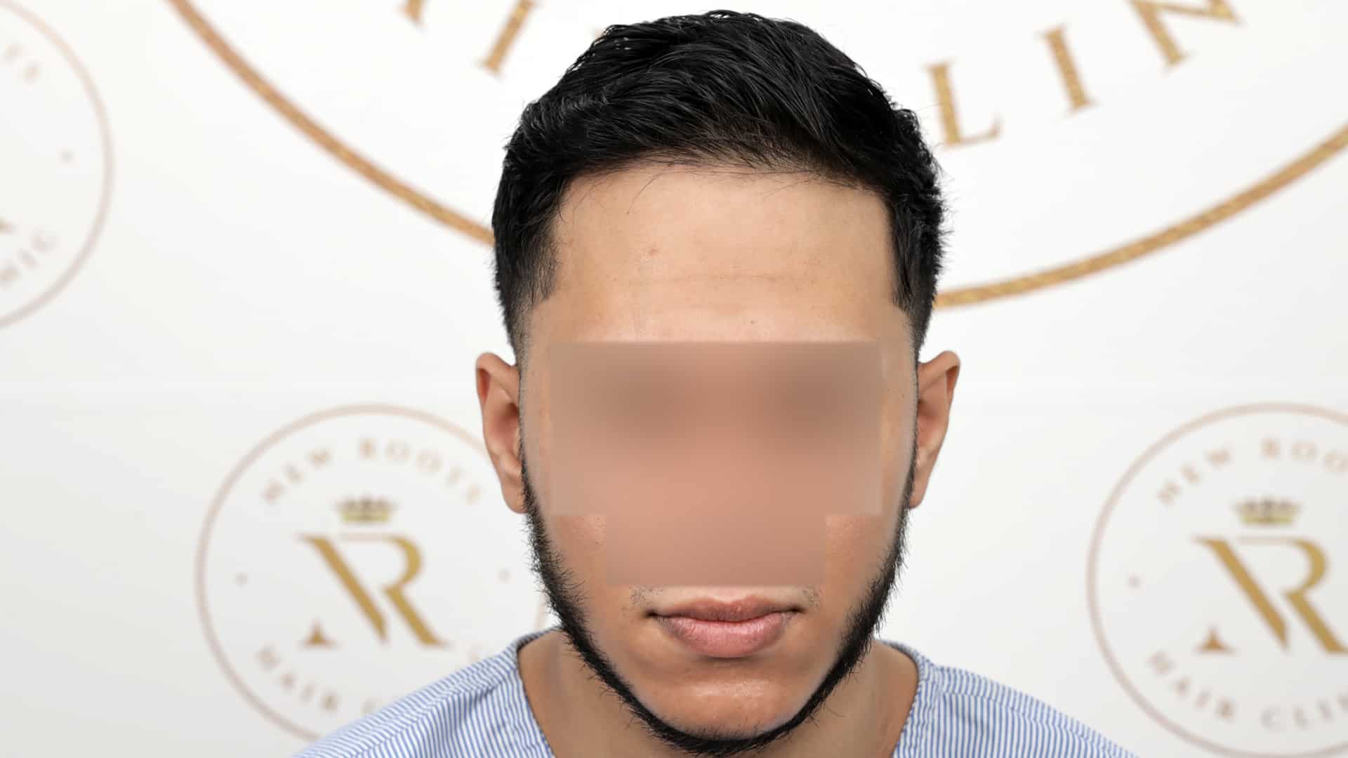 Beard Hair Transplant Before After Images