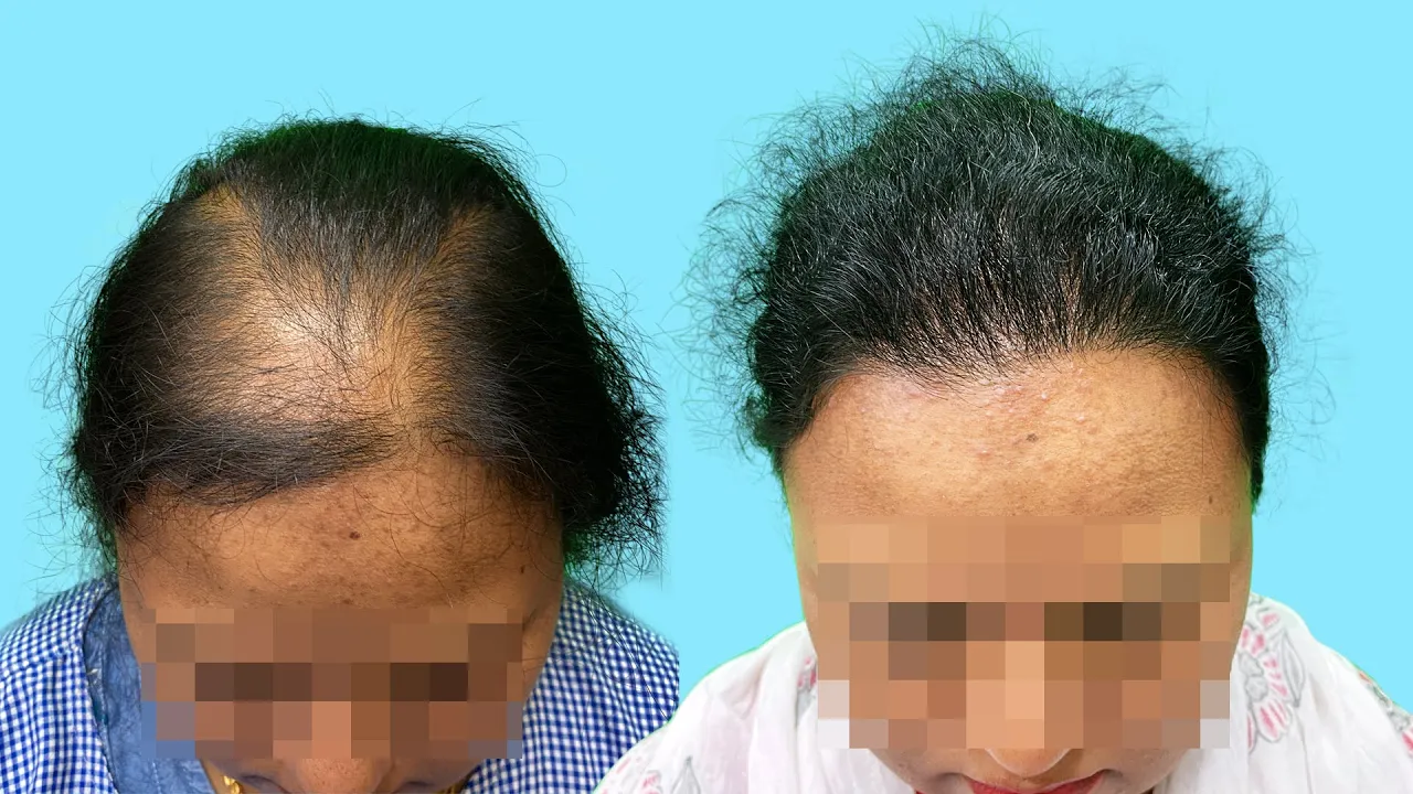 Female Hair Transplant Images